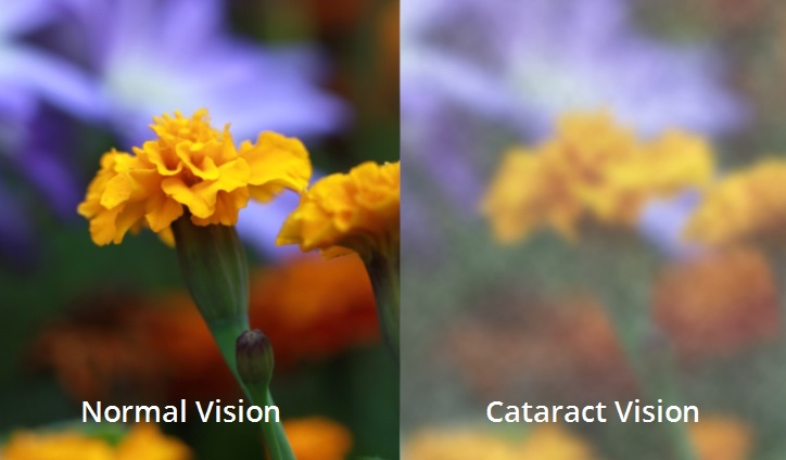 Normal vision - Cataract vision