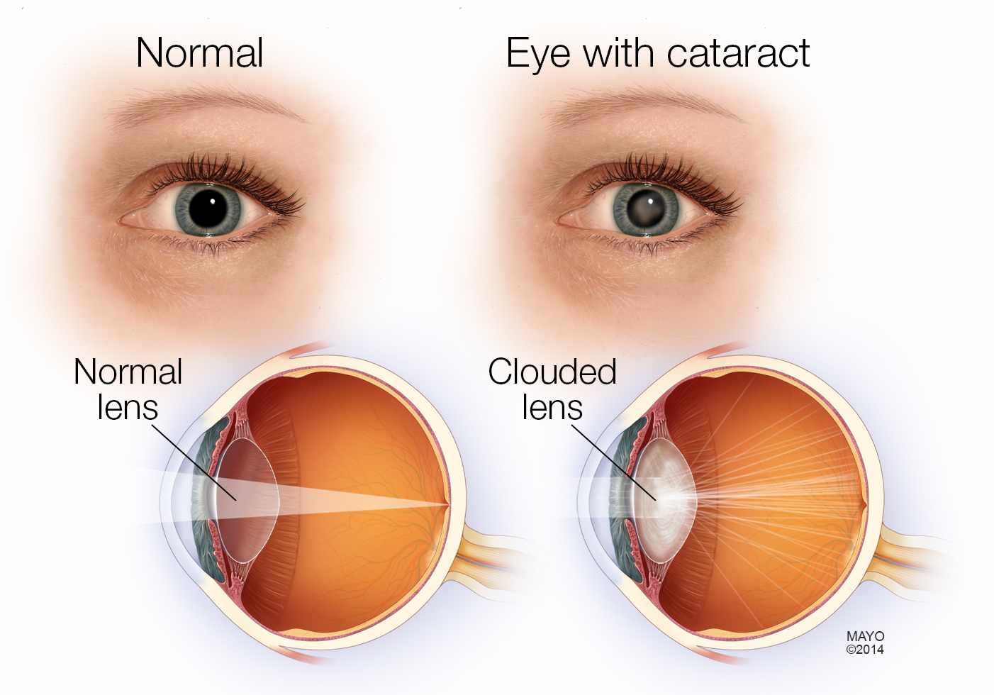 Normal and Cataract Eye