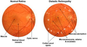 Normal Retina and Diabetic Retinopathy