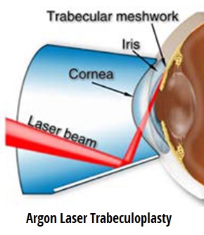 espiral balsa cable argon-laser-trabeculoplasty – Jaya Eye Care Centre is an NABH Accredited  Eye Care Hospital