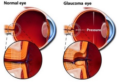 Normal Eye - Glaucoma Eye
