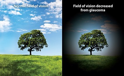 Normal Vison - Glaucoma Vision