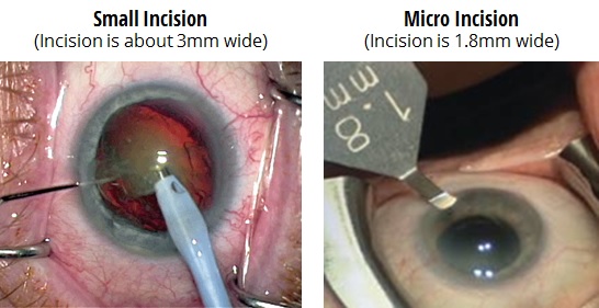 Comparison of Small Incision and Micro Incision Cataract Surgery