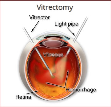 Vitreoretinal And Diabetic Related Eye Disorders