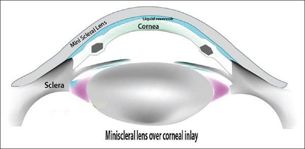 Mini Scleral Device (MSD) And Corneo Scleral Device (CSD) – A Boon To Those Who Have Keratoconus And Similar Corneal Irregularities!