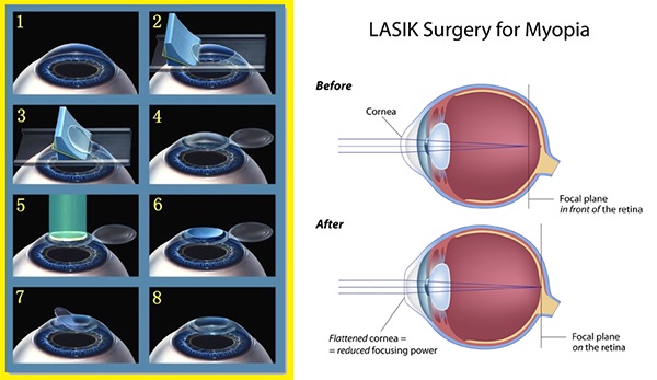 Precision LASIK Correction: Advanced Vision Techniques